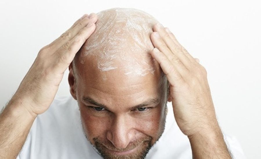 how to get a shiny bald head 3